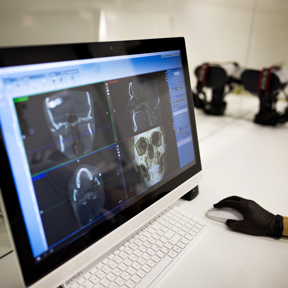 A computer screen displaying a 3D medical imaging scan of a human head with annotations, set against a white wall with a keyboard and mouse on a desk.